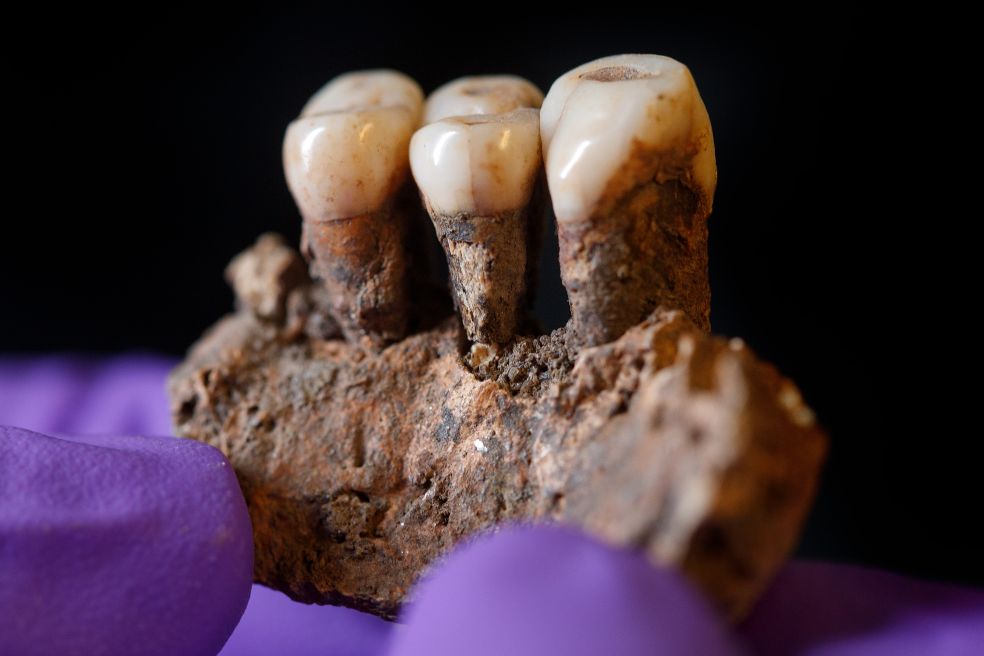 Tre tandproteser med benrest, hålls av en hand med lila handskydd.