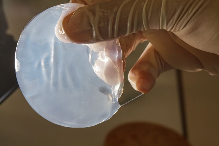 En hand i en kirurgisk handske håller en genomskinlig silikonimplantat.